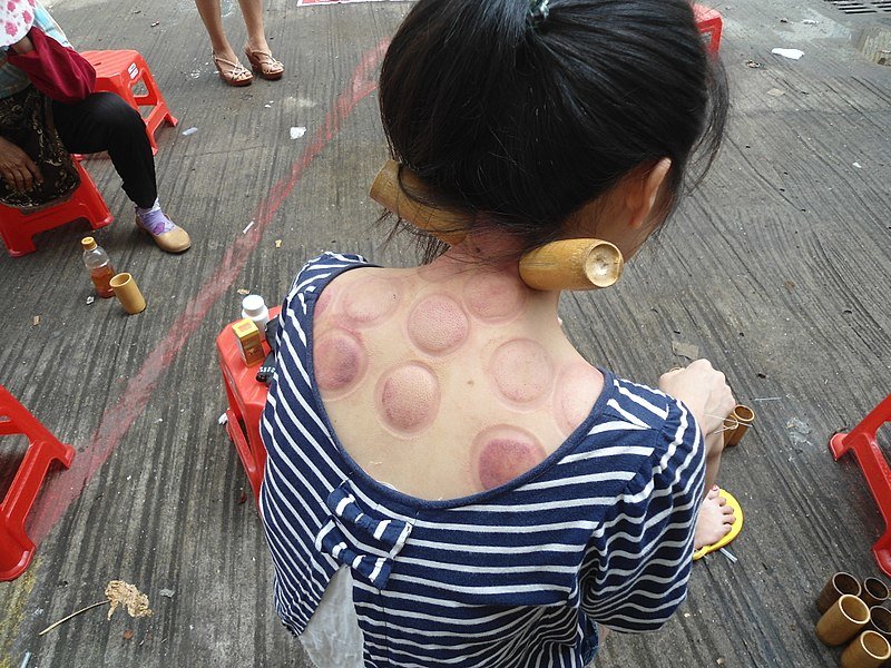 800px-Fire_cupping_in_Haikou_-_02.JPG