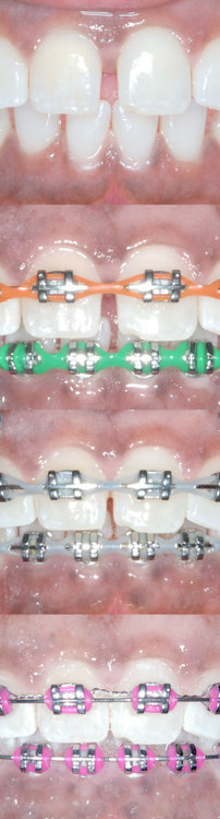 Braces_Close_Diastema_Spaces.jpg